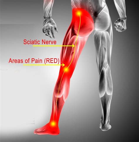 sciatic nerve compression test|sciatic nerve pain symptoms.